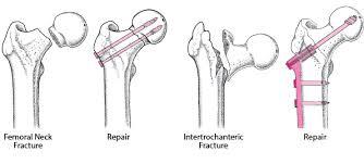 Open Reduction of Fracture